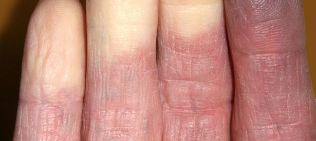 Supporting image for Coffee Break February:  Let’s Talk about the “Cold” hard facts of living with Raynaud’s Phenomenon & how Stopping Smoking can help 